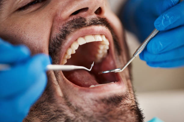 Best Knocked-Out Tooth (Avulsed Tooth) Treatment in Spring Creek, NV