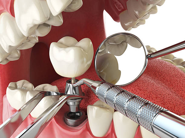 Best Emergency Root Canal Therapy in Spring Creek, NV